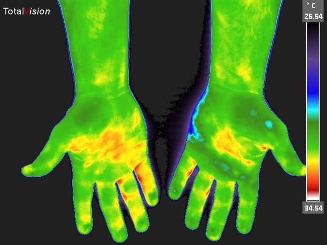 Thermal image of hands.